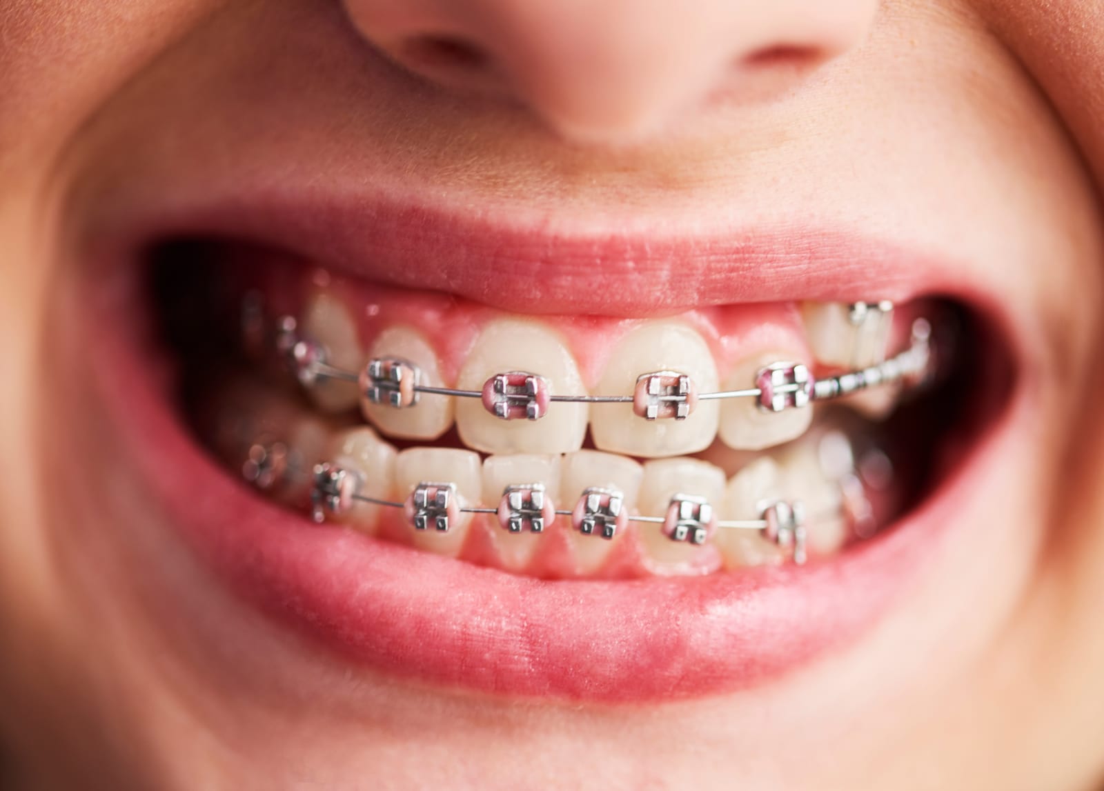Orthodontic preview