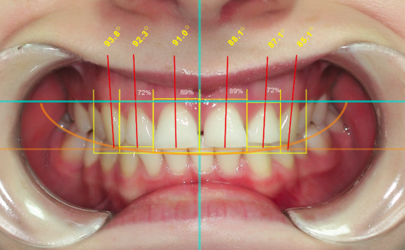 Smile analysis
